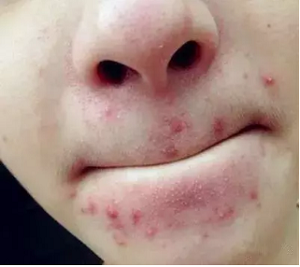 嘴巴周围长出来很多痘痘是怎么回事？