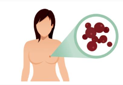 身体出现7个异常 可能乳腺癌“找上”你
