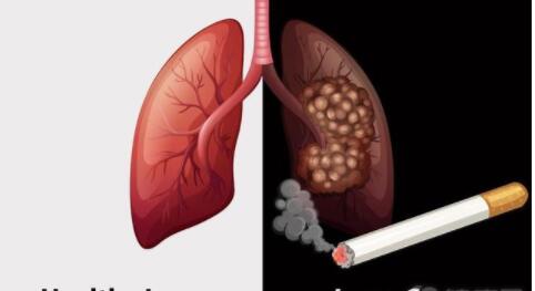 肺癌离世前3个症状