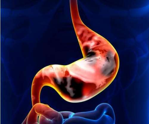 胃癌具体的可分为哪些类型？