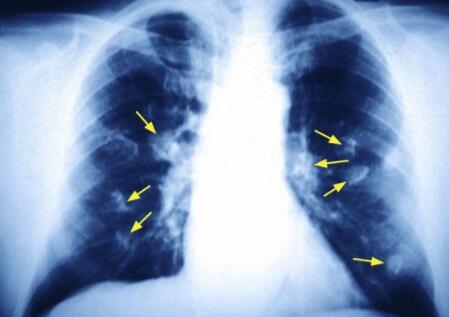 肺癌晚期不治疗 可以活多久 