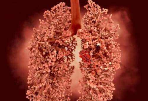 肺癌晚期如何续命
