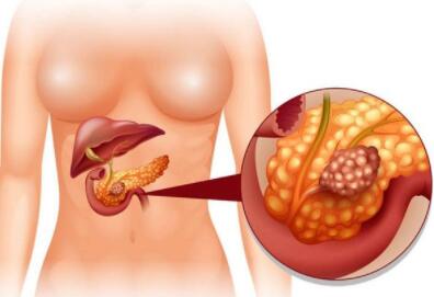 胰腺癌的早期症状是什么