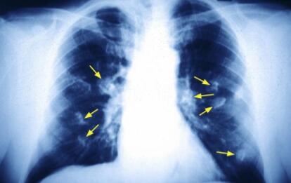 肺癌到了晚期 身体有什么感觉 5个症状很难熬 