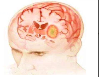 脑癌，真是一个让人“头疼”的东西