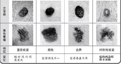 黑痣癌变只因常做足疗           黑痣和黑色素瘤的区别