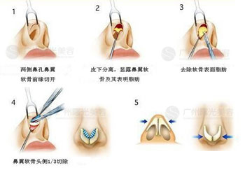 一般沿鼻翼缘作蝶形切口,分离皮肤暴露鼻翼软骨,将鼻翼软骨在穹窿部