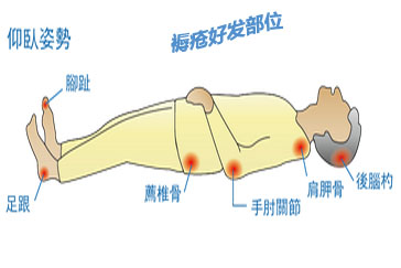 癌症褥疮如何产生怎么预防