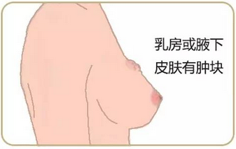 病人乳腺癌早期症状的图片