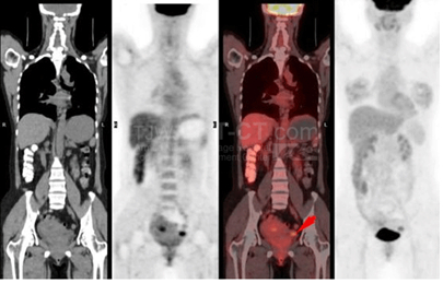 图为petct检查影像