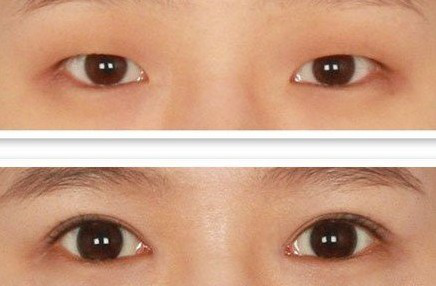 开内眼角和开外眼角有何区别