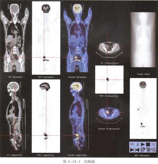 【pet-ct影像】【简要病史】患者,男,72岁.