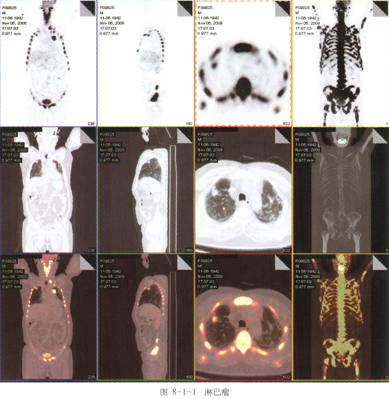 pet-ct确诊细胞淋巴瘤案例