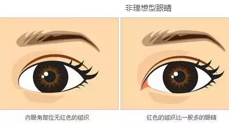 开眼角图文 20160323135845_72935.png
