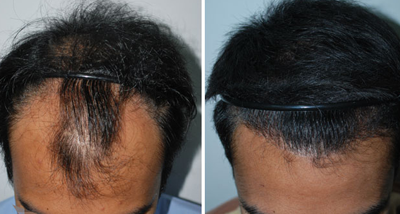 种植头发后五天:可选用中性,无刺激的洗发水,使用温水轻轻清洗种头发图片