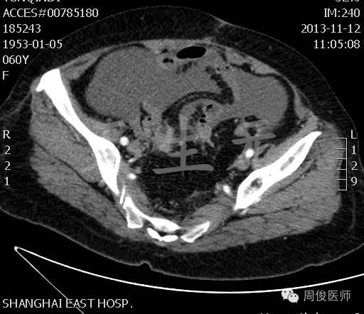 【经典案例】介入治疗晚期卵巢癌伴顽固性腹水——周俊