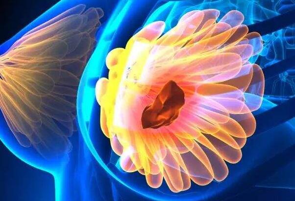 哪几种是常见的乳腺良性肿瘤