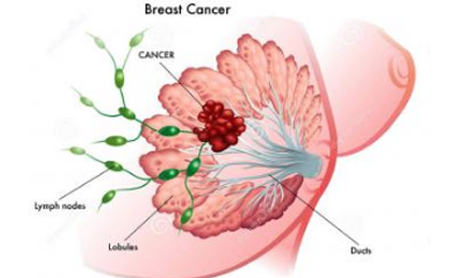 乳腺癌早期的4大症状