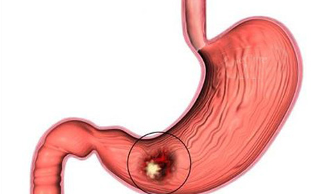 胃癌带来的危害有什么呢