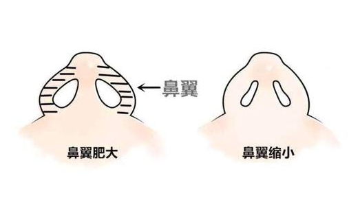 鼻翼缩小术 鼻翼缩小术