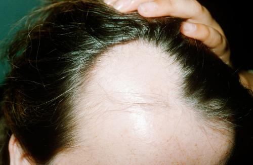 遗传性脱发有哪些特征呢？