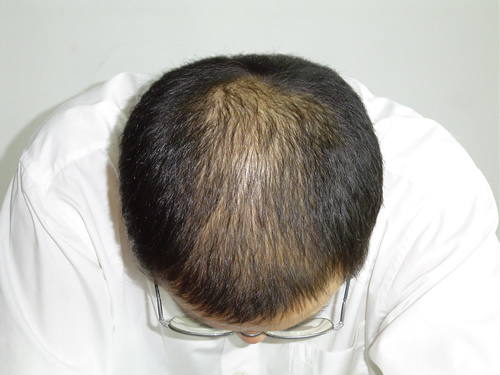 雄性脱发一般从多少岁开始？