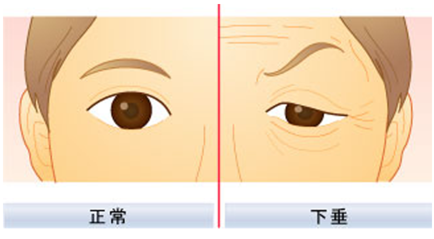 上瞼下垂矯正