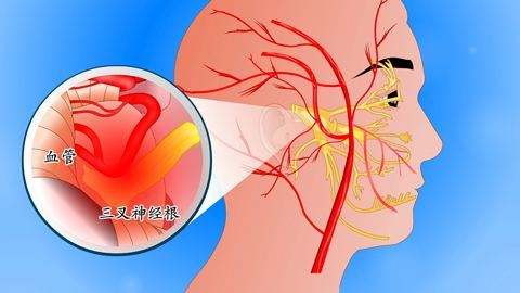 三叉神经痛伽玛刀治疗