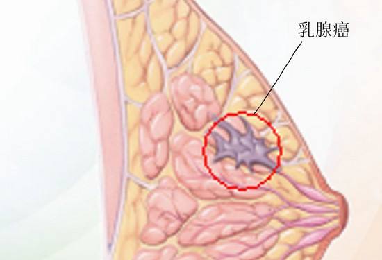 乳腺癌女性的危险