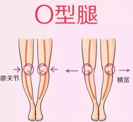 O型腿用矫正带能有效吗？