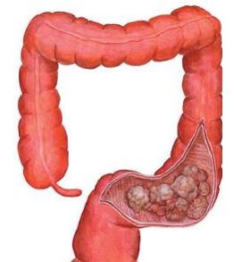 结肠癌的预防|发现肿块或息肉，应提高警惕结肠癌