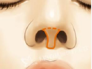 鼻小柱延长一般用什么材料