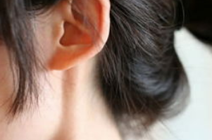 耳垂畸形矫正术有哪些类型