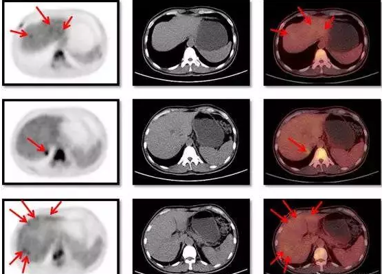 petct的肝癌图像.petct在肝胆系肿瘤诊断中的应用