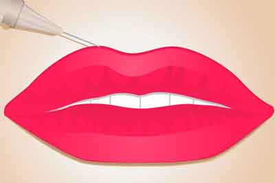 透明质酸丰唇如何护理