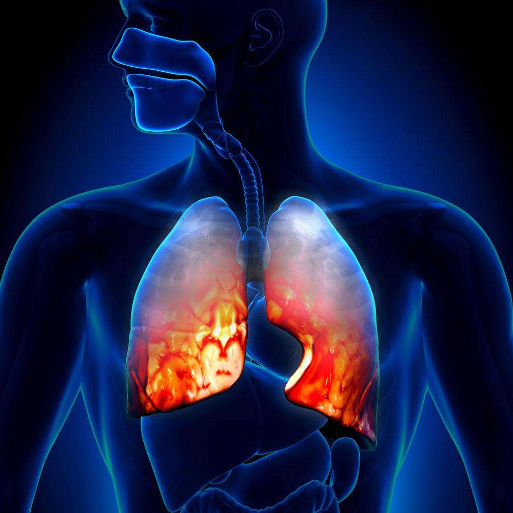 肺部病灶炎症还是癌症，你可分得清肺炎和肺癌？