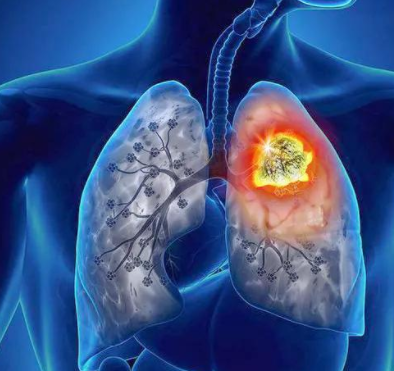 肺癌早期一定要做手术治疗吗？