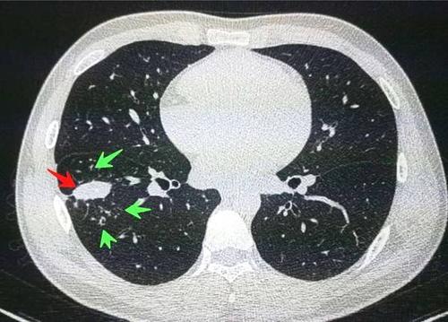 肺癌的分期类型有哪些