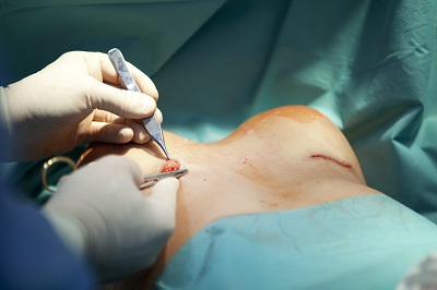 隆胸修复手术修复过程是怎样的呢？
