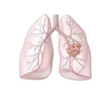 肺部长了肿瘤要怎么治疗？