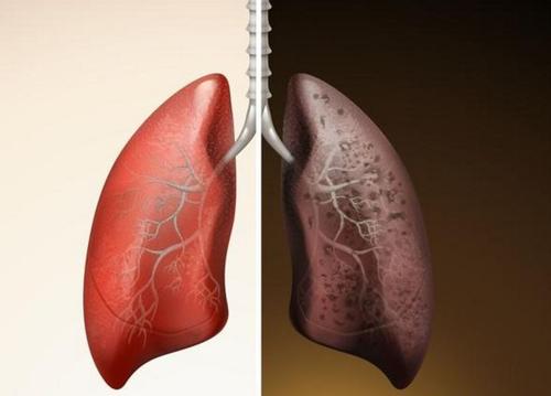 肺癌护理