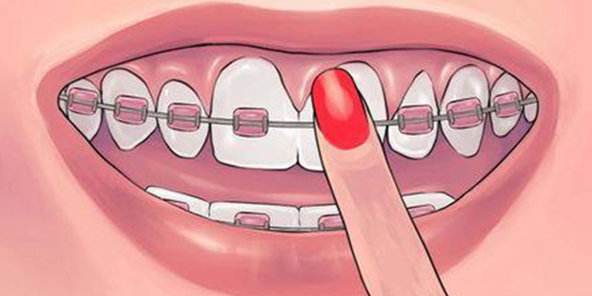 牙套是隐形牙套或是金属牙套，怎么选比较好？