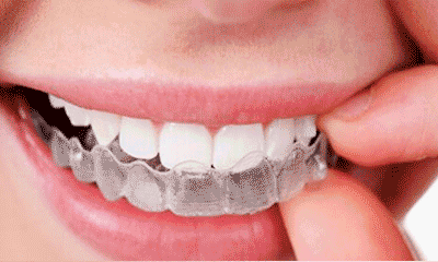 隐形牙套朋友在疫情宅家期间，遇到了牙套问题应该怎么应对？