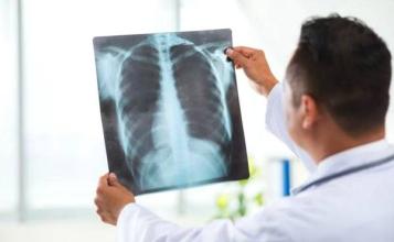 肺癌患者复查都有哪些检查项目？