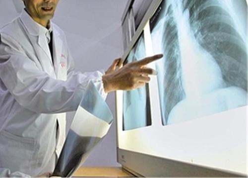 临床上可以通过哪些表现确诊肺癌？