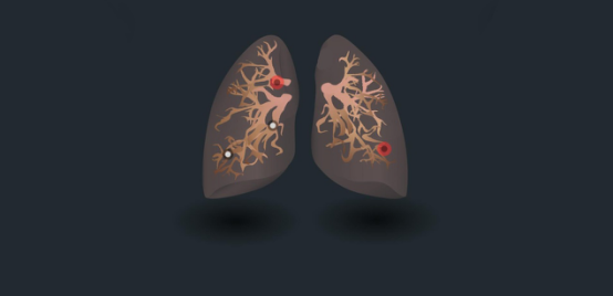 肺结节会发展成肺癌吗？
