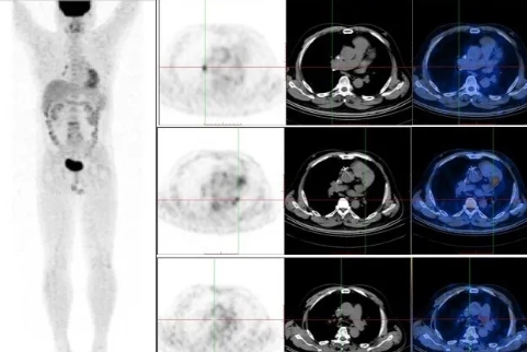 双核素显像在心脏结节病中的应用PETCT检查案例