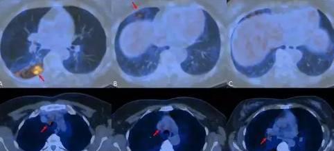 PETCT在新冠肺炎的运用PETCT检查案例