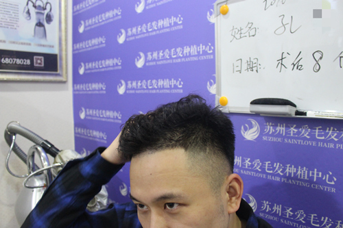 额角植发