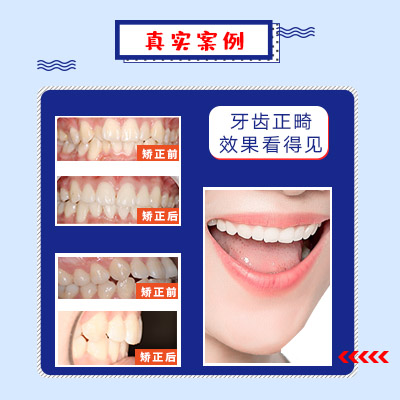 牙齿正畸